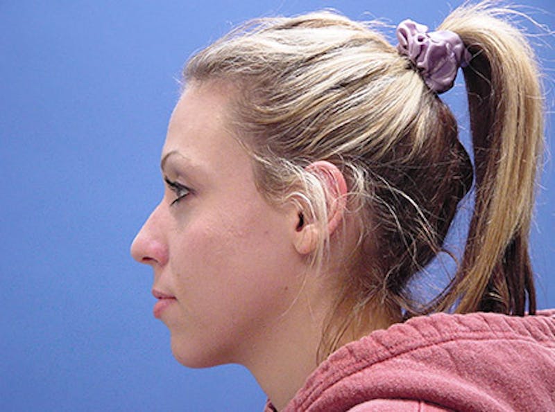 Primary Rhinoplasty Before & After Gallery - Patient 989585 - Image 5