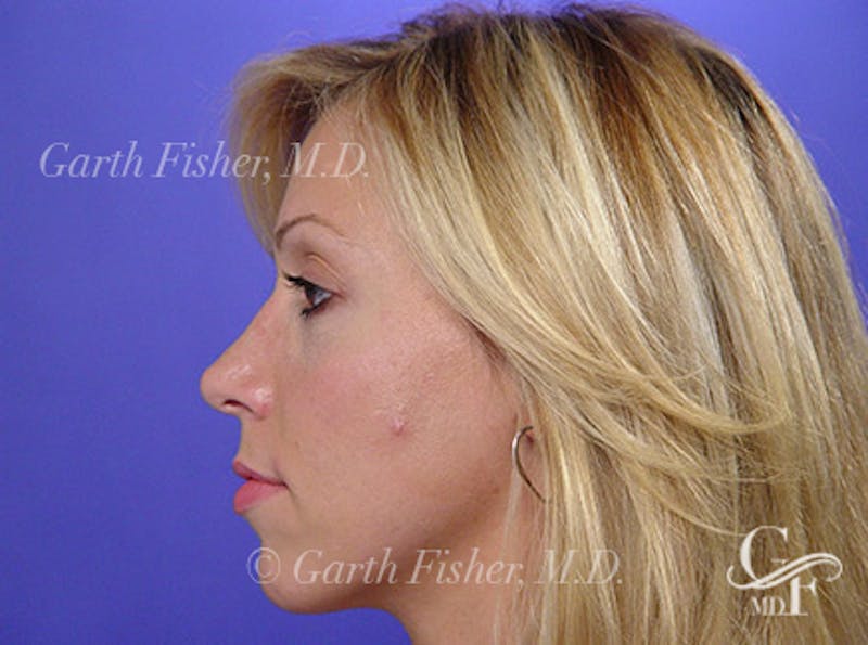Primary Rhinoplasty Before & After Gallery - Patient 989585 - Image 6