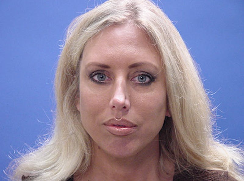 Primary Rhinoplasty Before & After Gallery - Patient 324145 - Image 1