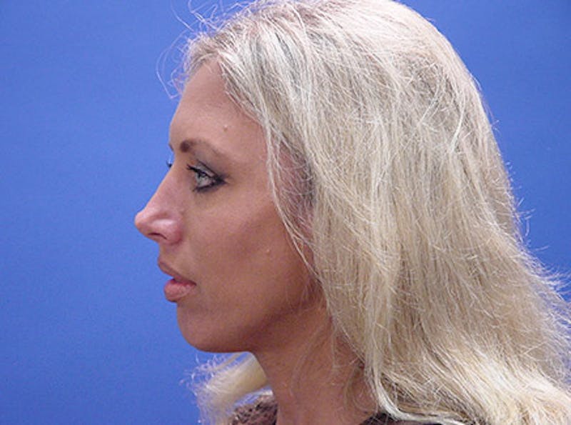 Primary Rhinoplasty Before & After Gallery - Patient 324145 - Image 5