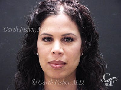 Ethnic Rhinoplasty Before & After Gallery - Patient 239204 - Image 2