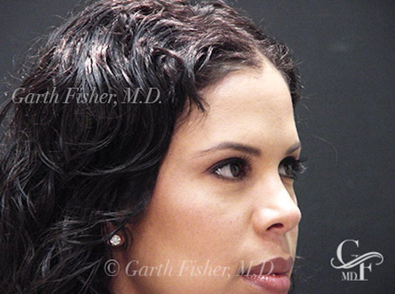 Ethnic Rhinoplasty Before & After Gallery - Patient 239204 - Image 4