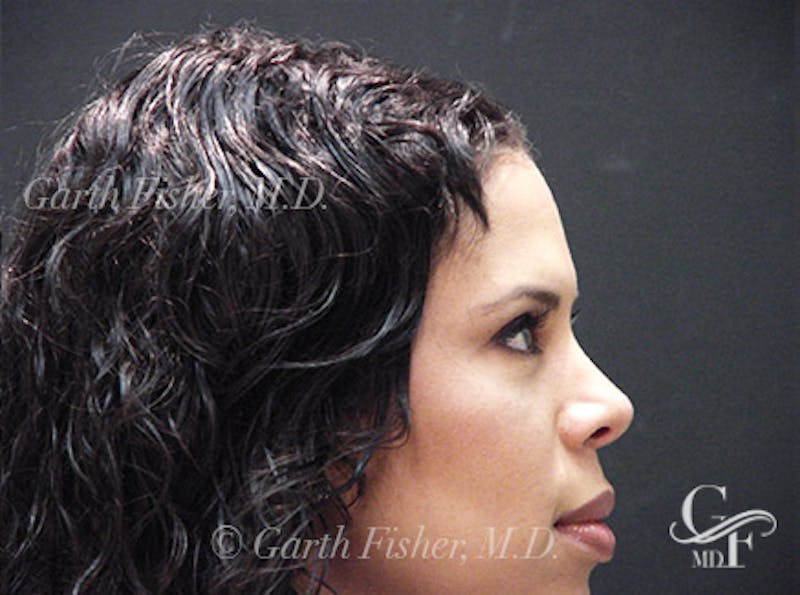 Ethnic Rhinoplasty Before & After Gallery - Patient 239204 - Image 6