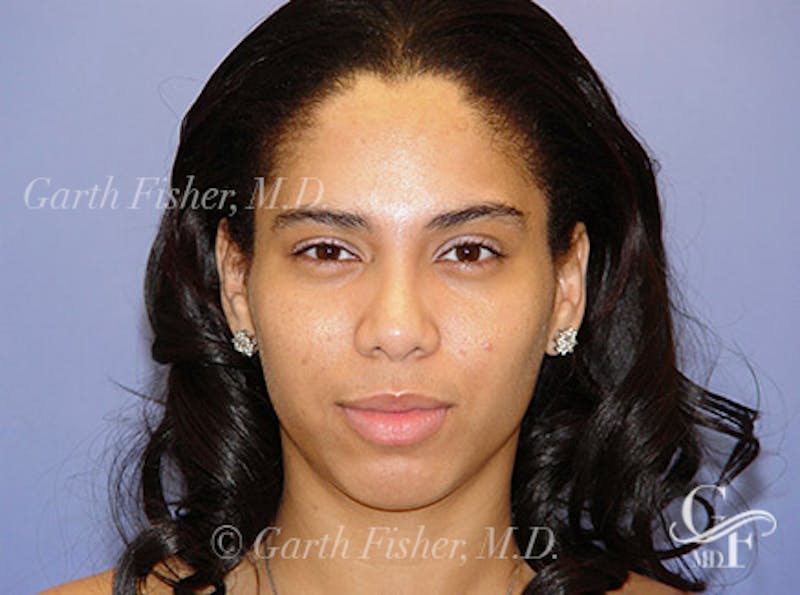 Ethnic Rhinoplasty Before & After Gallery - Patient 155270 - Image 2