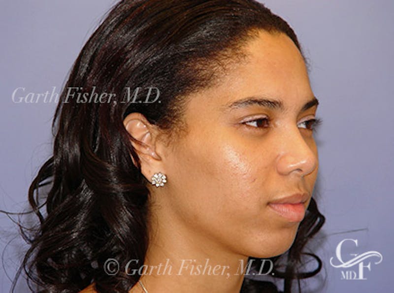Ethnic Rhinoplasty Before & After Gallery - Patient 155270 - Image 4