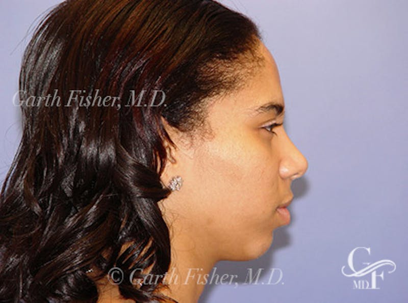 Ethnic Rhinoplasty Before & After Gallery - Patient 155270 - Image 6