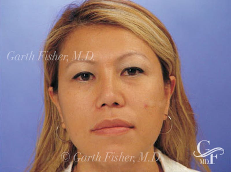 Ethnic Rhinoplasty Before & After Gallery - Patient 117053 - Image 2