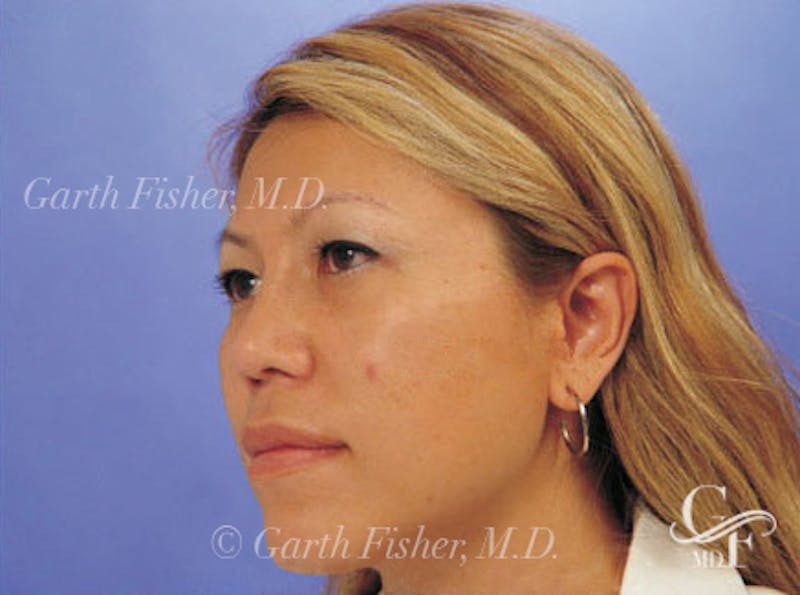 Ethnic Rhinoplasty Before & After Gallery - Patient 117053 - Image 4