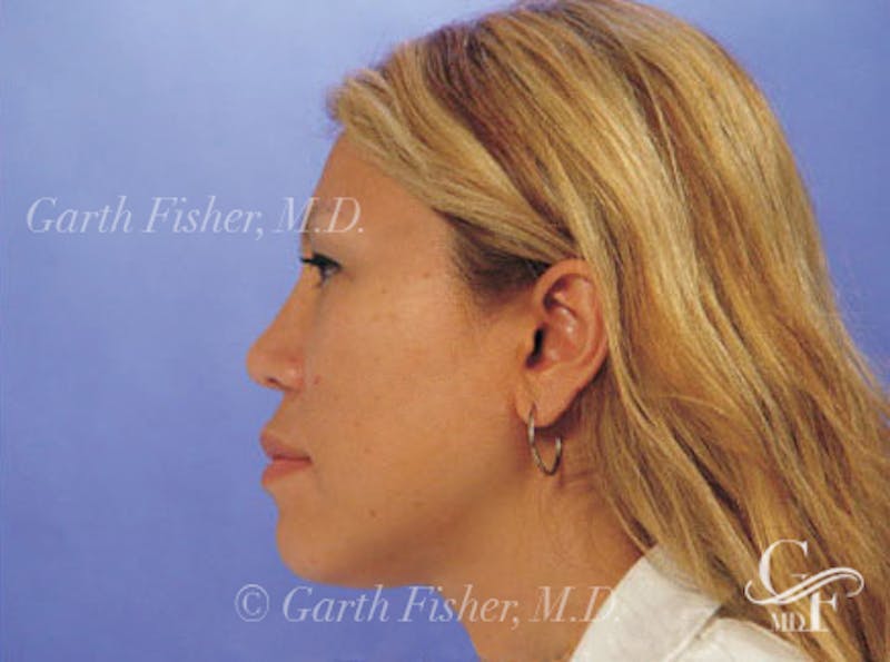 Ethnic Rhinoplasty Before & After Gallery - Patient 117053 - Image 6