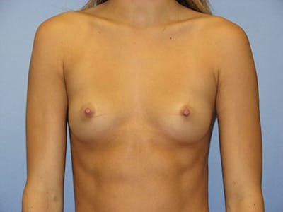 Breast Augmentation Before & After Gallery - Patient 362794 - Image 1