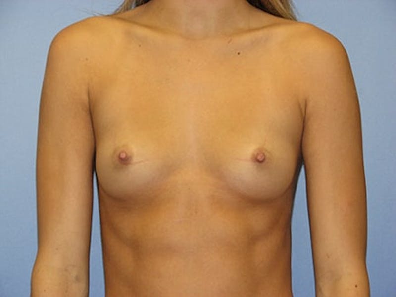 Breast Augmentation Before & After Gallery - Patient 362794 - Image 1