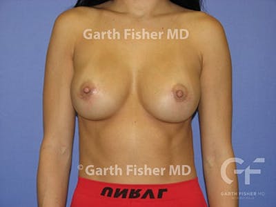 Breast Augmentation Before & After Gallery - Patient 362794 - Image 2