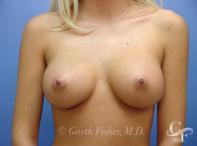 Breast Augmentation Before & After Gallery - Patient 360483 - Image 2
