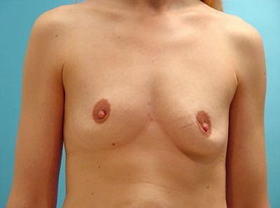 Breast Augmentation Before & After Gallery - Patient 954828 - Image 1