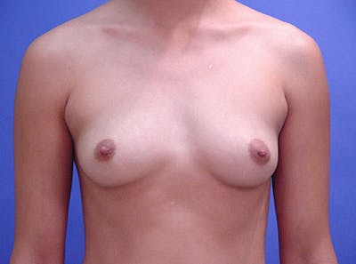 Breast Augmentation Before & After Gallery - Patient 239639 - Image 1