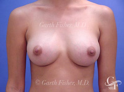 Breast Augmentation Before & After Gallery - Patient 239639 - Image 2