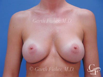 Breast Augmentation Before & After Gallery - Patient 246208 - Image 2
