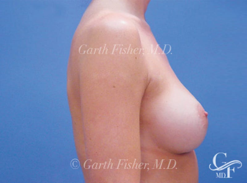 Breast Augmentation Before & After Gallery - Patient 246208 - Image 6