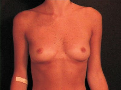 Breast Augmentation Before & After Gallery - Patient 904857 - Image 1