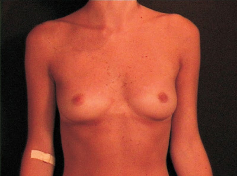 Breast Augmentation Before & After Gallery - Patient 904857 - Image 1