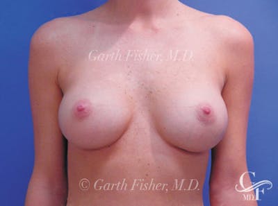 Breast Augmentation Before & After Gallery - Patient 904857 - Image 2