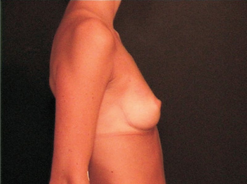 Breast Augmentation Before & After Gallery - Patient 904857 - Image 5