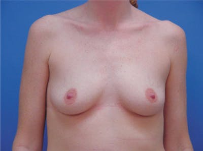Breast Augmentation Before & After Gallery - Patient 107124 - Image 1