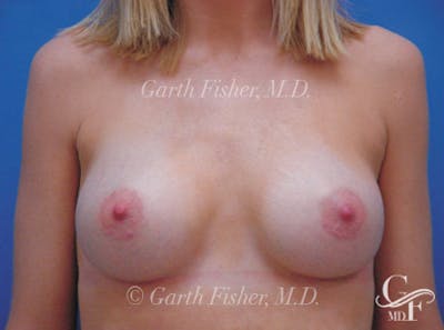 Breast Augmentation Before & After Gallery - Patient 107124 - Image 2