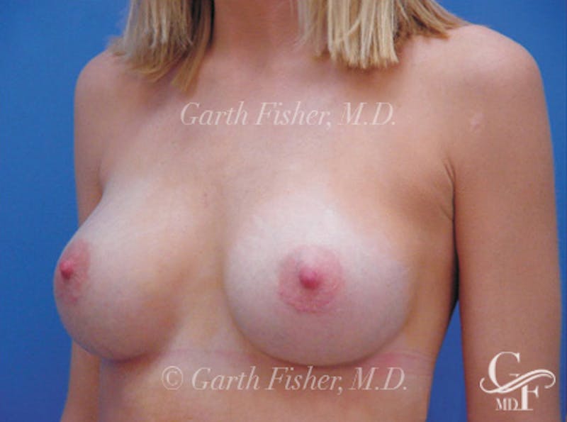 Breast Augmentation Before & After Gallery - Patient 107124 - Image 4