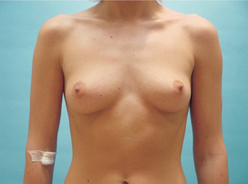 Breast Augmentation Before & After Gallery - Patient 370535 - Image 1