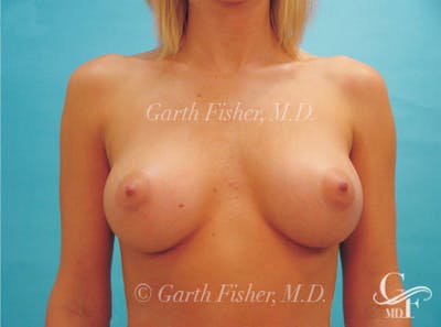 Breast Augmentation Before & After Gallery - Patient 370535 - Image 2