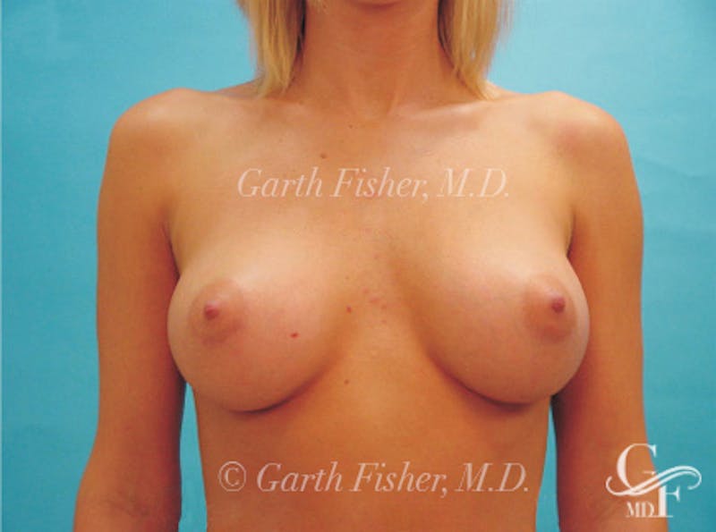 Breast Augmentation Before & After Gallery - Patient 370535 - Image 2