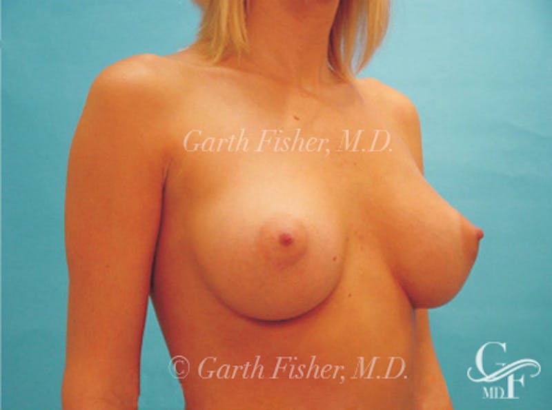 Breast Augmentation Before & After Gallery - Patient 370535 - Image 4