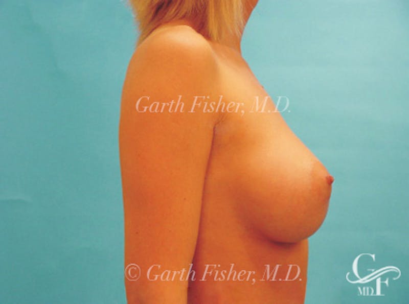 Breast Augmentation Before & After Gallery - Patient 370535 - Image 6