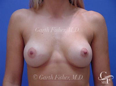 Breast Augmentation Before & After Gallery - Patient 933752 - Image 2