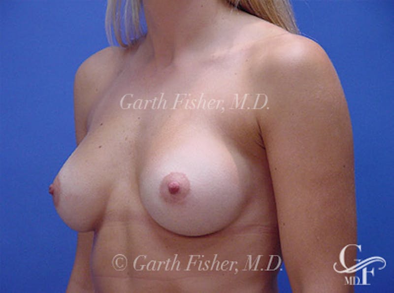 Breast Augmentation Before & After Gallery - Patient 933752 - Image 4