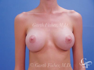 Breast Augmentation Before & After Gallery - Patient 371598 - Image 2