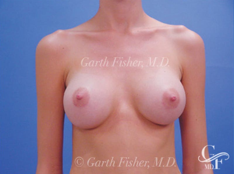 Breast Augmentation Before & After Gallery - Patient 371598 - Image 2