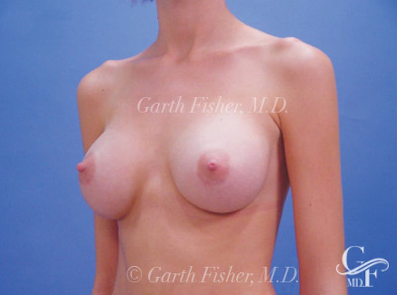 Breast Augmentation Before & After Gallery - Patient 371598 - Image 4