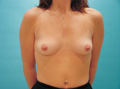 Breast Augmentation Before & After Gallery - Patient 162918 - Image 1