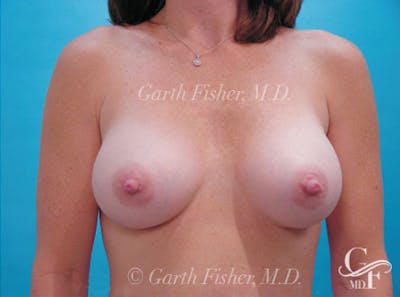 Breast Augmentation Before & After Gallery - Patient 162918 - Image 2