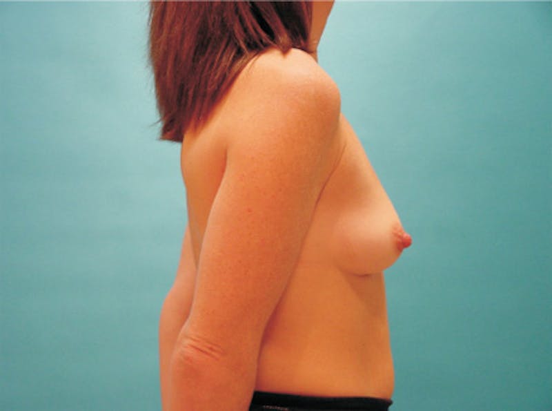 Breast Augmentation Before & After Gallery - Patient 162918 - Image 5