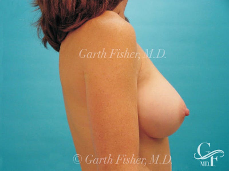 Breast Augmentation Before & After Gallery - Patient 162918 - Image 6