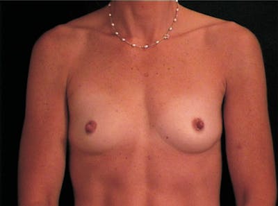 Breast Augmentation Before & After Gallery - Patient 239315 - Image 1