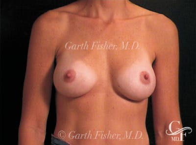 Breast Augmentation Before & After Gallery - Patient 239315 - Image 2