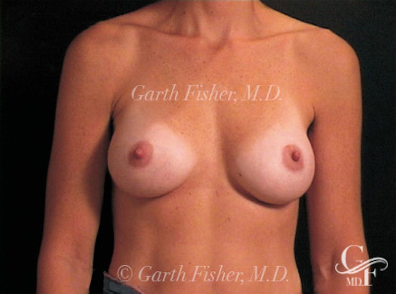 Breast Augmentation Before & After Gallery - Patient 239315 - Image 2