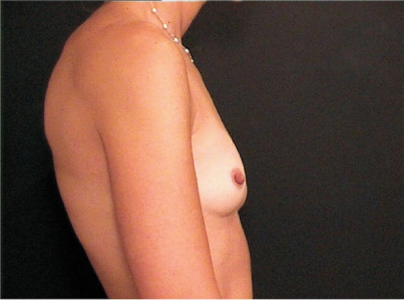 Breast Augmentation Before & After Gallery - Patient 239315 - Image 5
