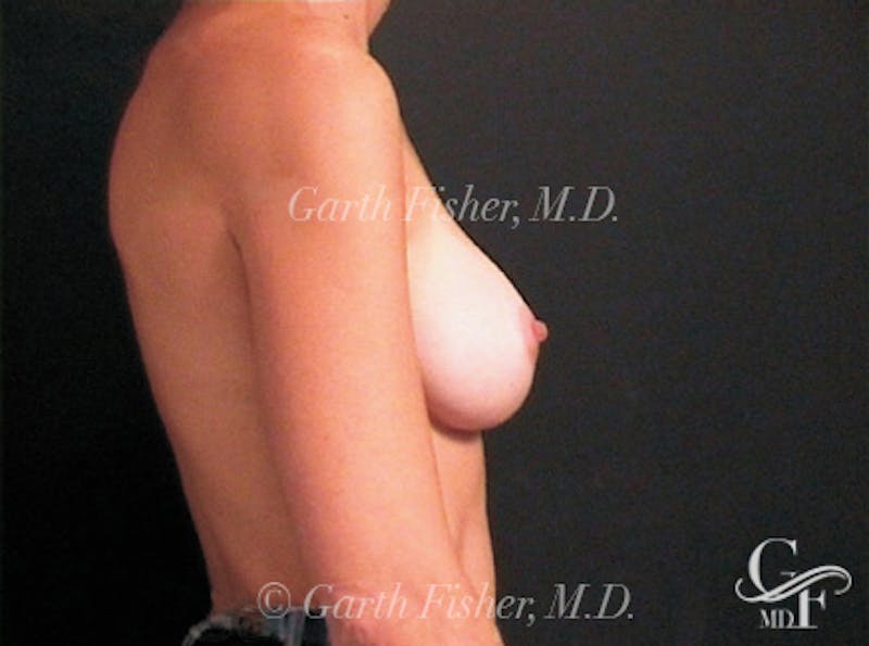 Breast Augmentation Before & After Gallery - Patient 239315 - Image 6