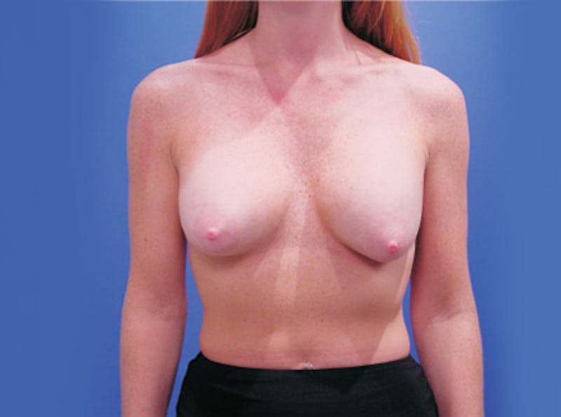 Breast Lift Before & After Gallery - Patient 199709 - Image 1