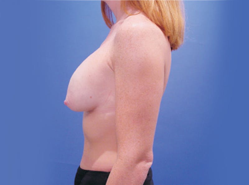 Breast Lift Before & After Gallery - Patient 199709 - Image 5